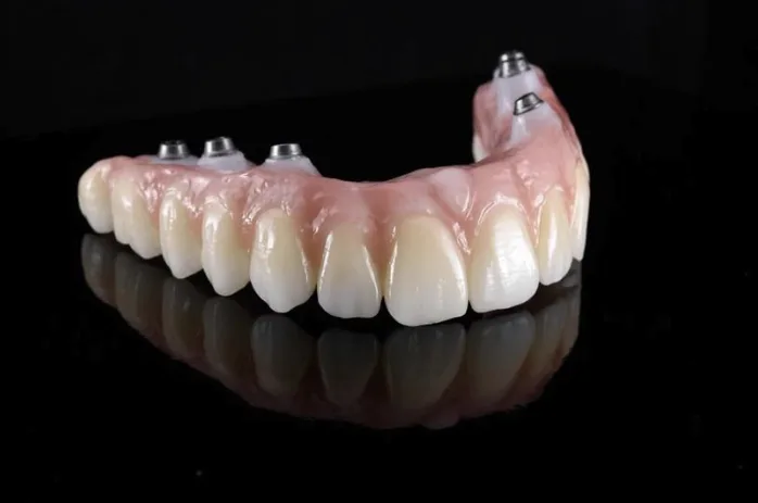 Image of dental Implants