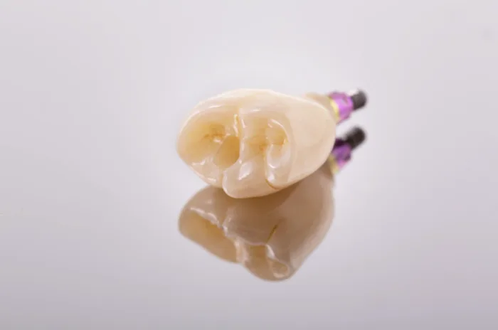 Modeless Dental Implant image