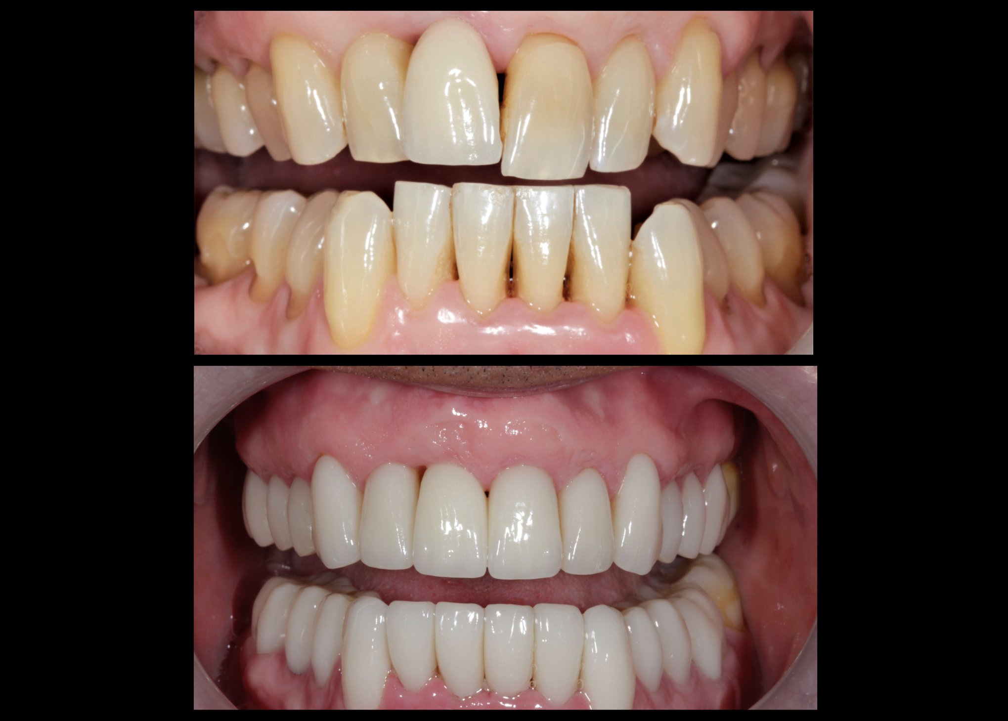 Image of before and after of high-end dental prosthetics