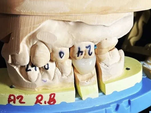 Crown and Bridge Model with numbers and data shown