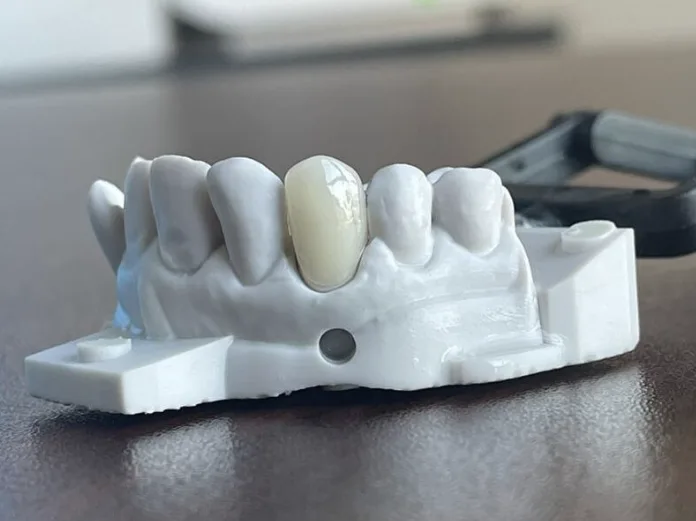Model of teeth with Emax Lithium Disilicate