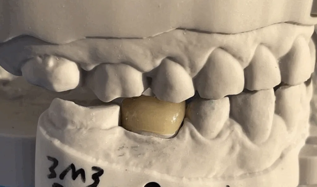 Model with lithium disilicate