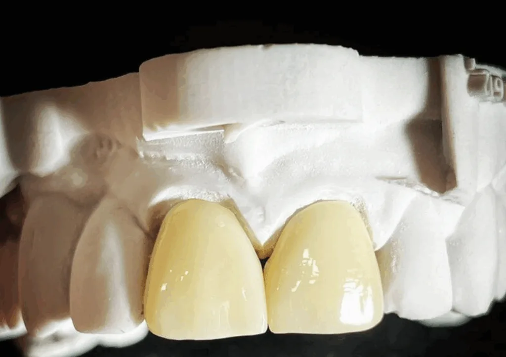 Image of porcelain crown model