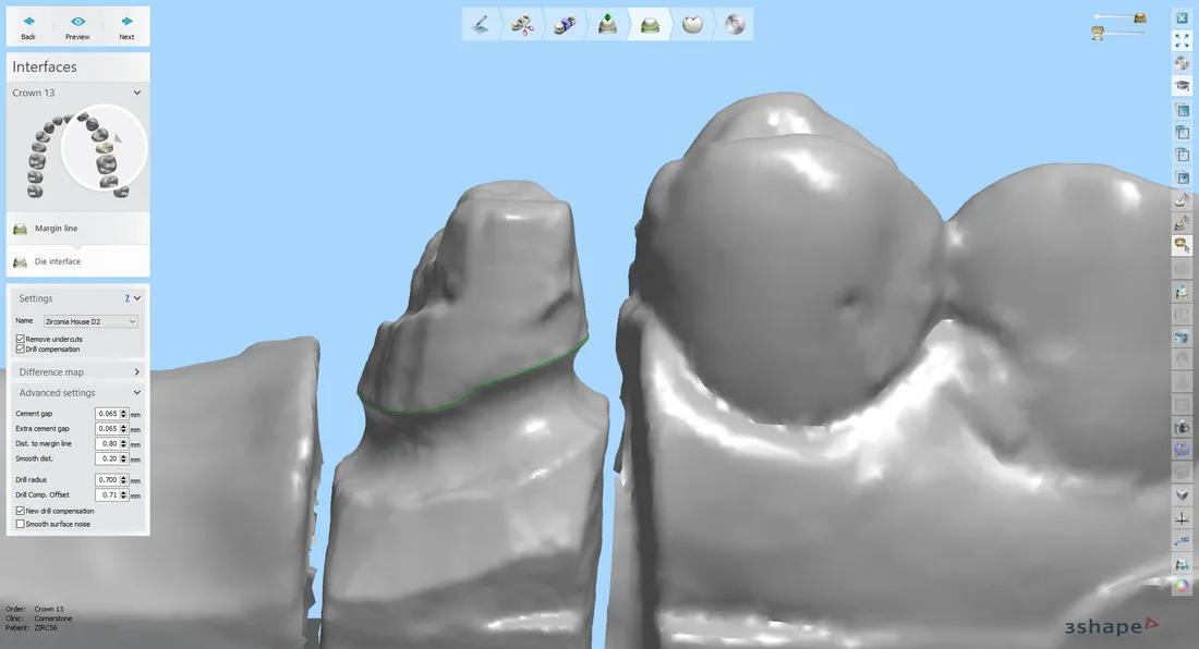 Scan of teeth for dental restoration
