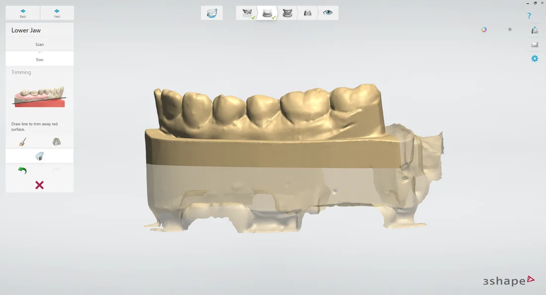 digital scan of teeth